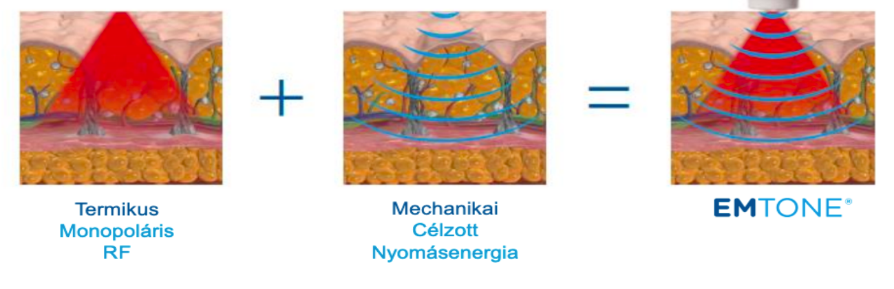 EMTONE kettős technológia